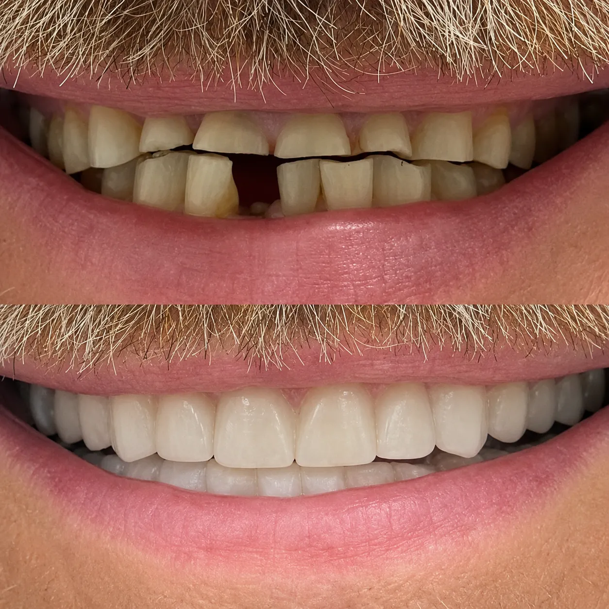 Before and after: broken and gapped front teeth restored to a full, even smile