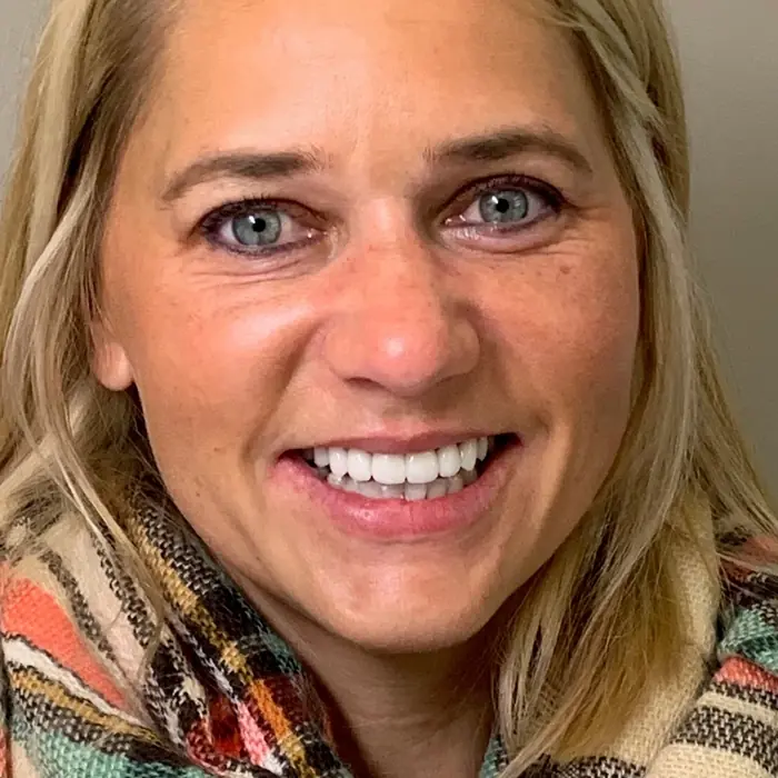 After treatment — A whiter, more confident smile