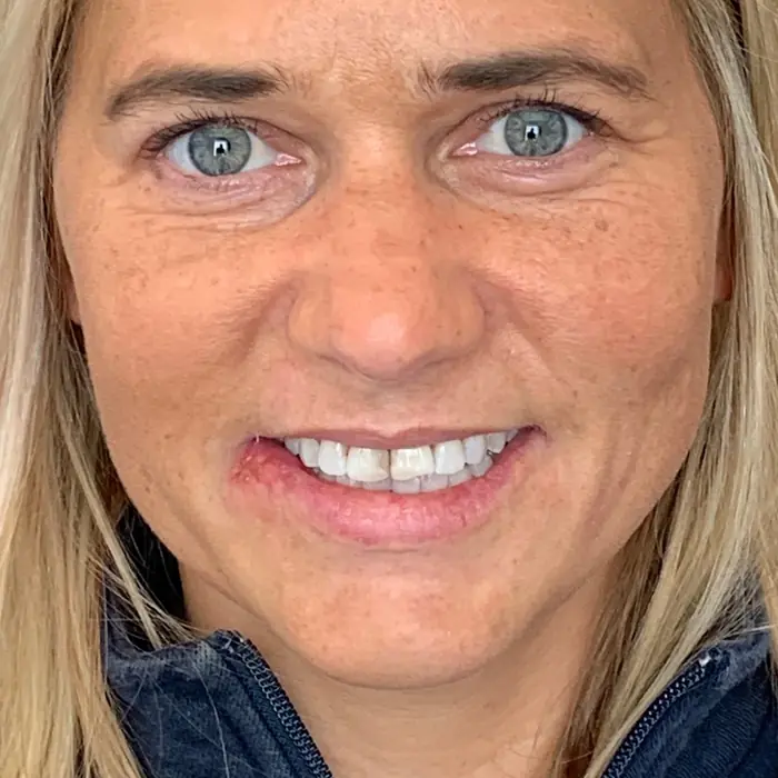 Before treatment — A whiter, more confident smile